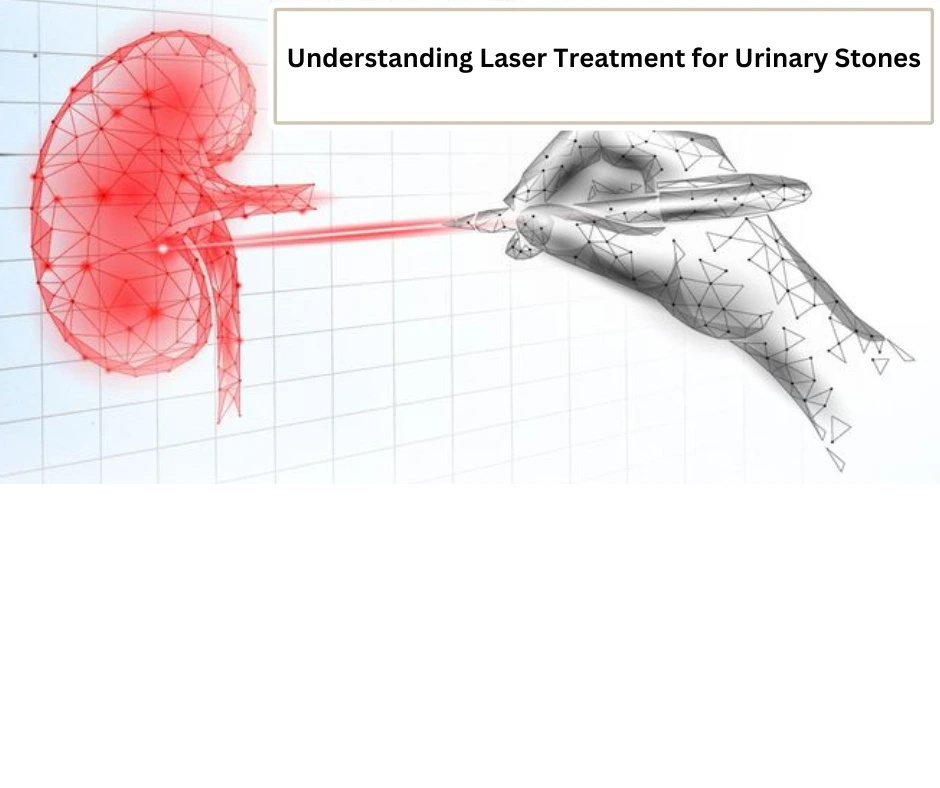 Laser Treatment Urinary Stones