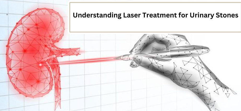 Understanding Laser Treatment for Urinary Stones