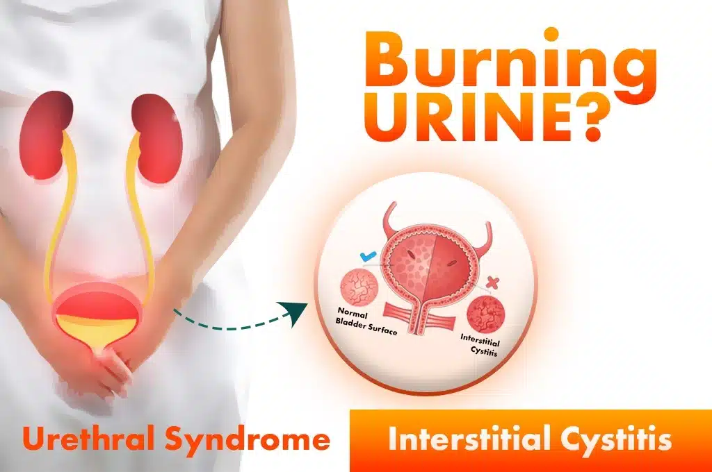 burning sensation while passing urine