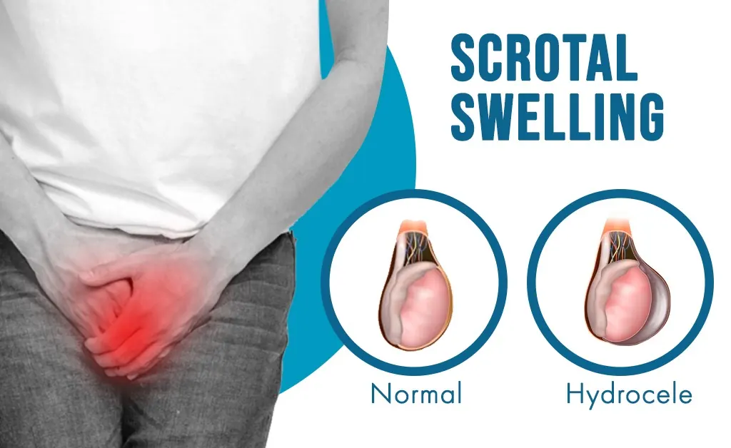 Scrotal Swelling