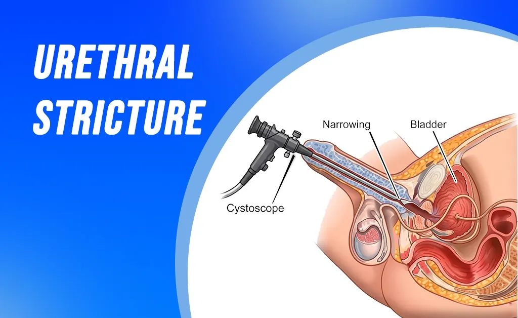 Urethral Stricture