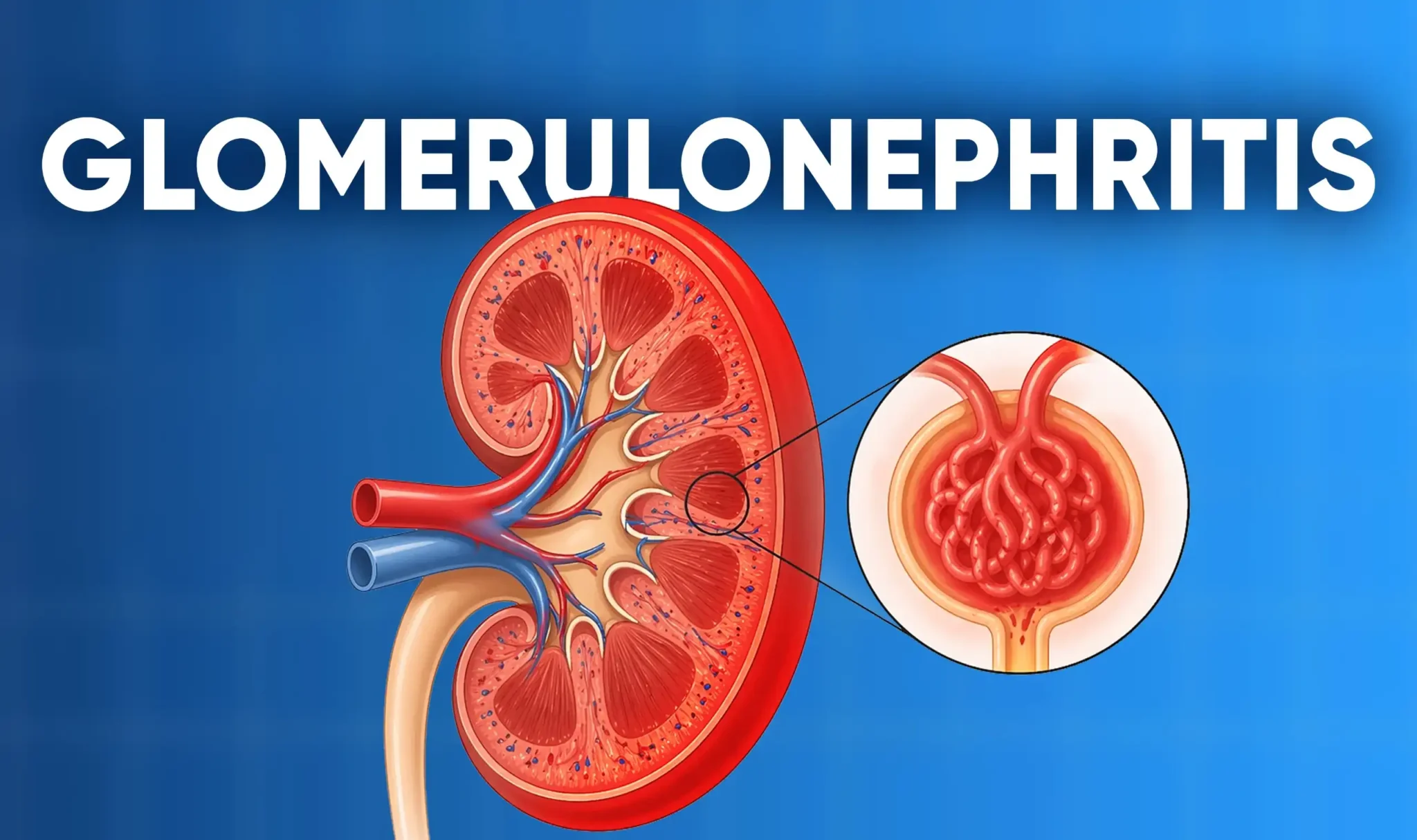 What Is Glomerulonephritis
