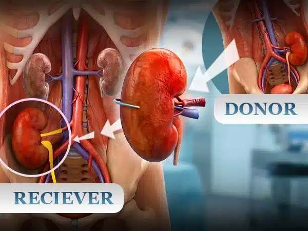 Kidney transplant vedanayagam hospital